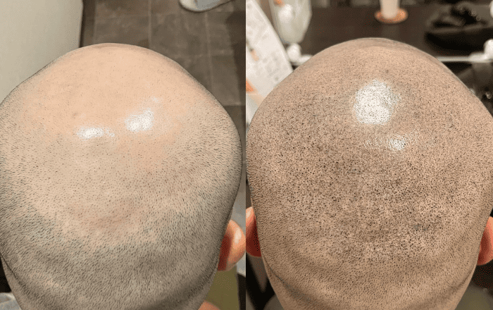 01 薄毛や脱毛、傷跡対策に