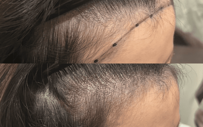 04 生え際にシャドウをいれる施術で小顔効果