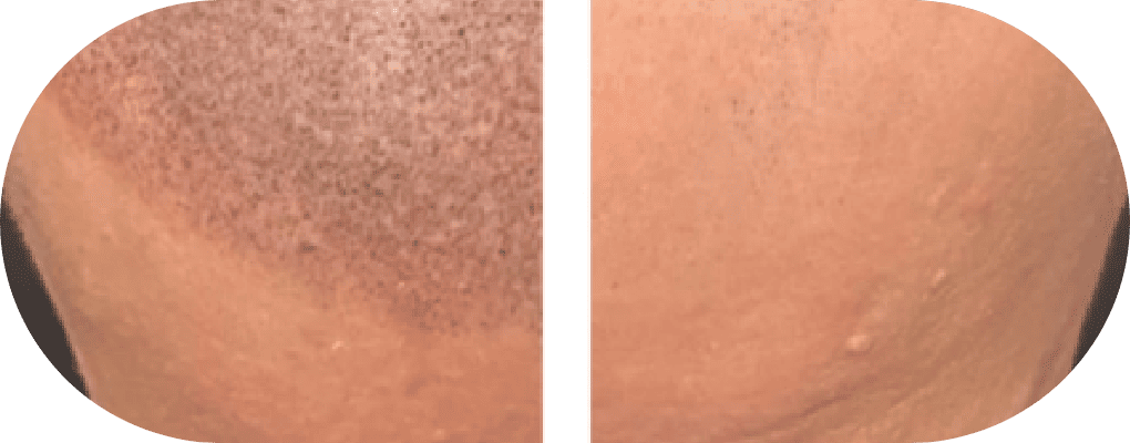 02 4D技術で自然な頭皮を再現