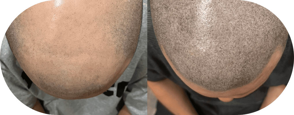 03 薄毛対策の新しい技術