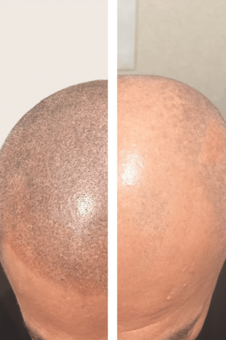 01 感動の頭皮再現性！