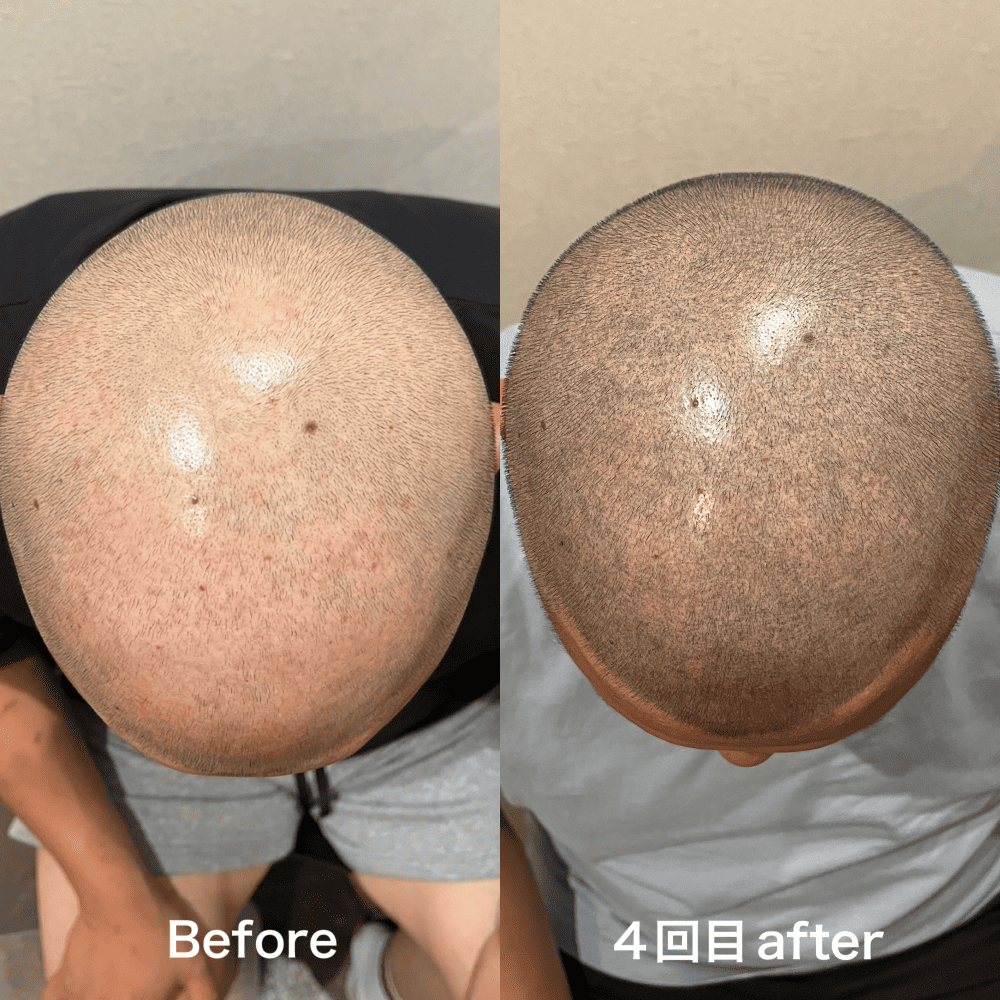 ALL OVER (全頭) 施術例