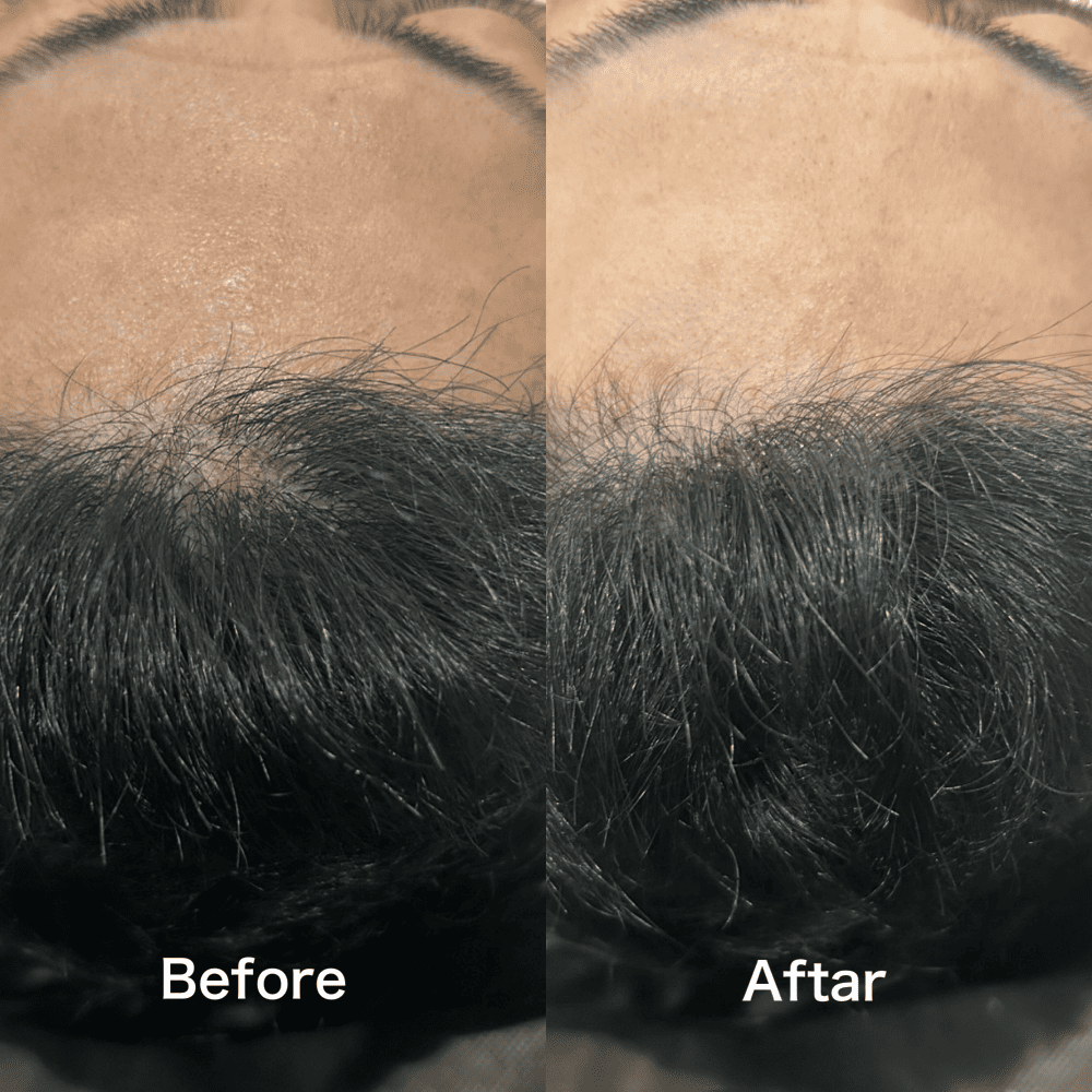 HAIR LINE (生え際) 施術例