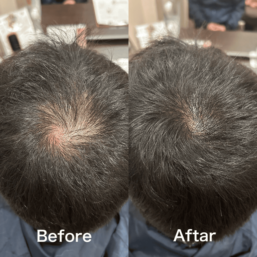 TOP OF HEAD (頭頂部) 施術例