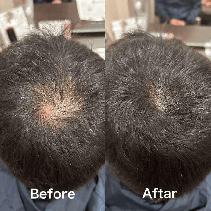 TOP OF HEAD (頭頂部) 施術例